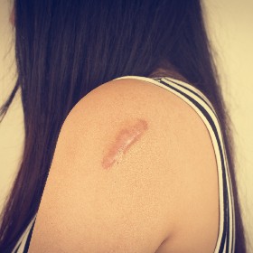 Dermatólogo Ambato Tratamiento Cicatrices